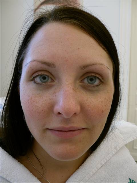 vor der Pigmentierung