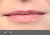 images/Referenzen/lippen/Foto_A_3.png