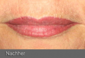 images/Referenzen/lippen/Foto_A_6.png