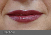 images/Referenzen/lippen/Foto_C_4.png